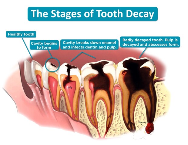 what do cavities look like before the treatment